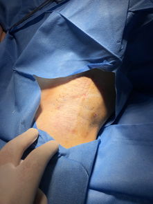 黄金微针射频治疗腋臭 原创