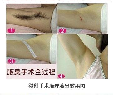 有腋臭就该 躺平 腋臭怎么治疗最合适