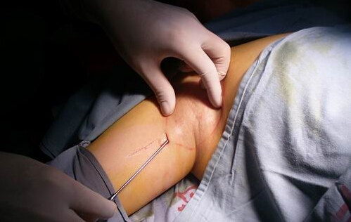 腋臭 狐臭 都有哪些治疗方法