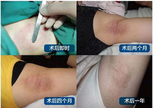 夏日除腋臭,九洲医院特邀天方腋谭创始人陈斌坐镇