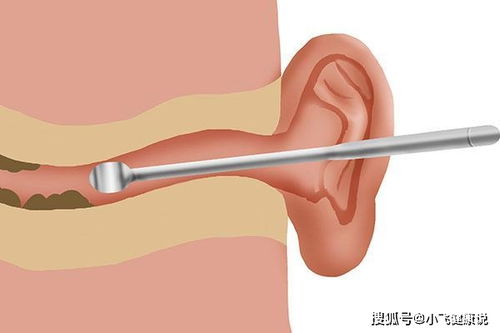 耳屎多是什么原因 学会正确处理耳屎,它是耳道健康的维护员