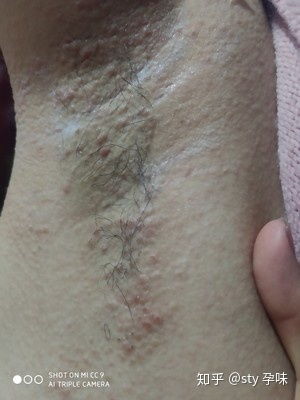 狐臭怎么办 手术可以根治吗 我来告诉大家