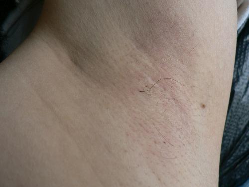 我是一名教师,令我头疼得是有腋臭,真是尴尬,用许多产品都不能有很好疗效,腋臭做手术后能彻底根治吗