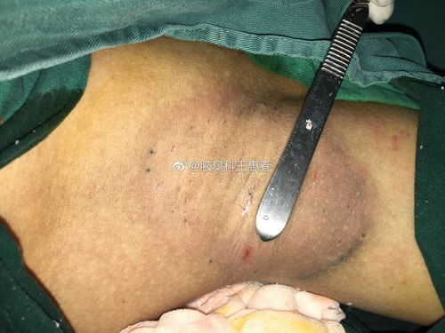 腋臭微切口 1厘米 根除实例,2017版