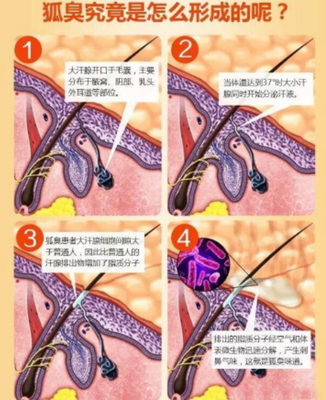 腋下狐臭知多少 告诉你哪些方法去腋臭最佳_企业新闻_中国贸易金融网