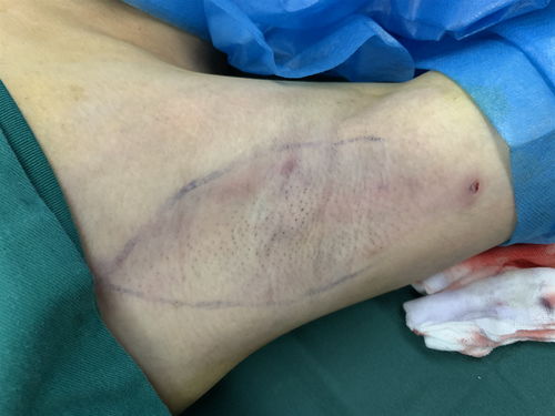 夏天来了,贵阳很多朋友都在了解做完腋臭微创手术后的恢复期