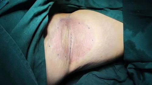 围观 有味道 的手术,治疗五花八门的腋臭 第医线