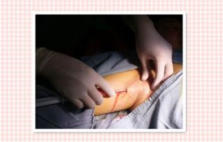 做狐臭手术是不是很痛 术后疼痛感因人而异