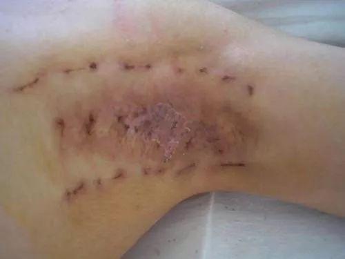 尴尬的遗传 狐臭 ,原来这样就可以轻松解决