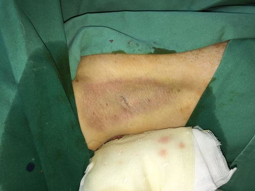 腋臭进行手术切除大汗腺可根治,手术应在青春期后做,会遗传