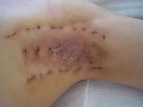 有腋臭怎么办 只需简单一喷一涂,轻松赶走狐臭异味