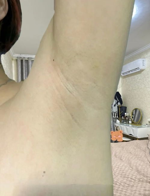 诊了 原来这就是感染狐臭的征兆