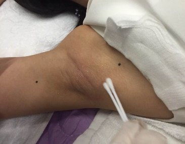 miradry微波无创治疗腋臭及腋下多汗