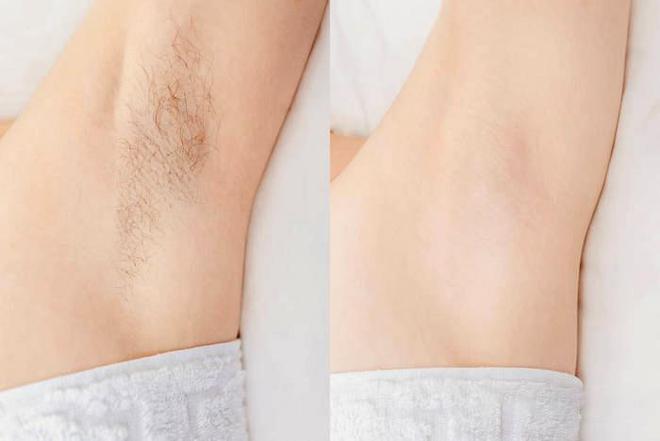 郑州科大医院腋臭专科:除臭就要与众不同|手术|微创|切口|大汗腺_网易