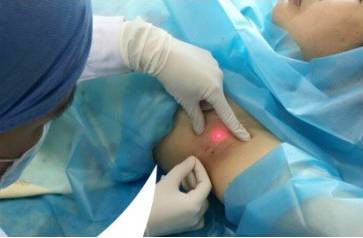 涨知识｜腋毛太多真的会导致腋臭吗？科学解读腋臭与狐臭的真相