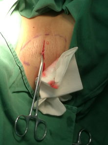 腋臭的微创手术 告别困扰，重拾自信