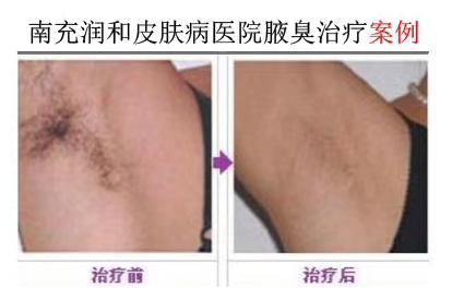 夏日狐臭之忧，科学应对告别尴尬